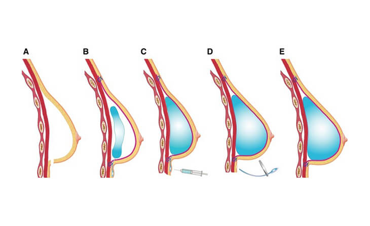 Insight on Capsular Contracture and Breast Augmentation