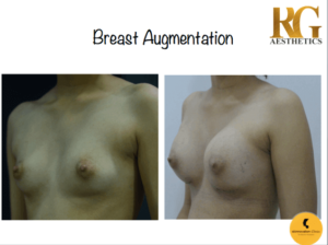 How to Fix Uneven Breast Implants - Dr Rajat Gupta