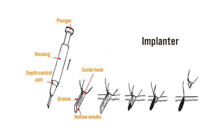 Hair transplant procedure