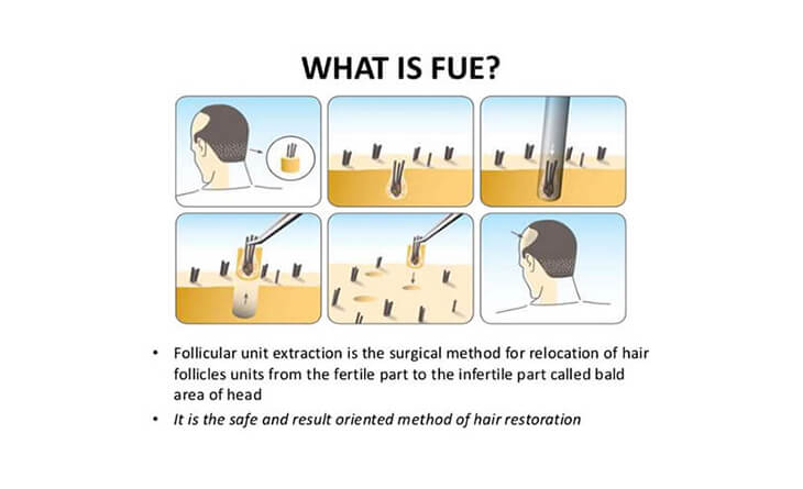 Hair transplant procedure