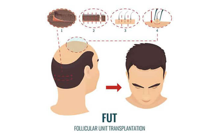 Hair transplant procedure