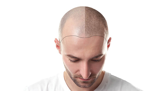 Hair Transplant in Delhi