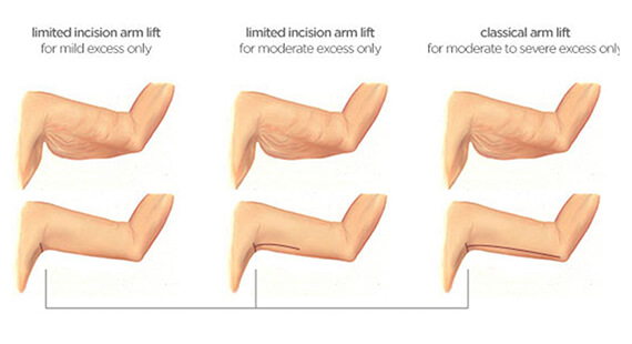 Arm Lift Surgery in Delhi