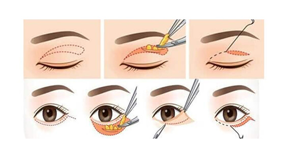 Asian Blepharoplasty in Delhi