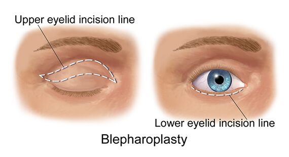 Blepharoplasty eyelid surgery delhi