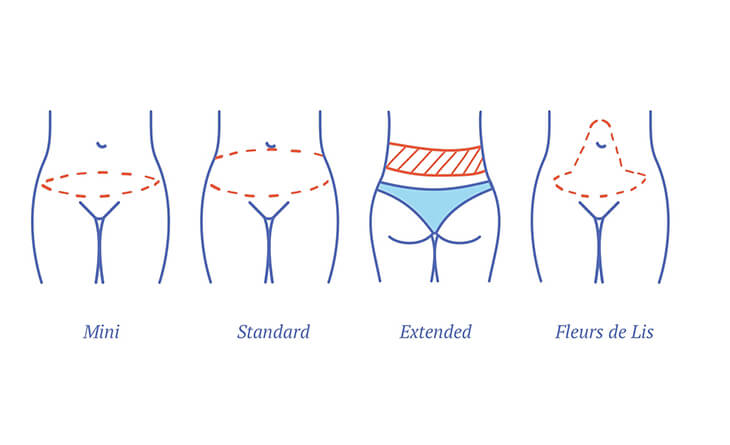 What Are The Different Types of Tummy Tuck Surgeries?