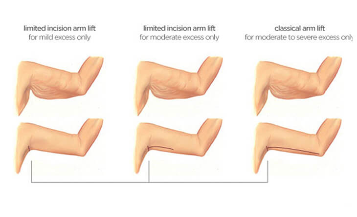 Arm Lift Surgery Procedure