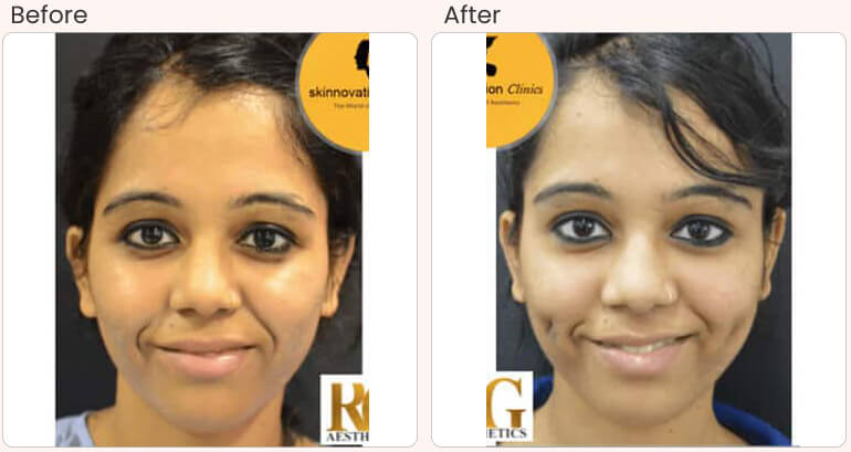 Dimple Creation Surgery In Delhi Dimple Surgery Cost Dr Rajat Gupta