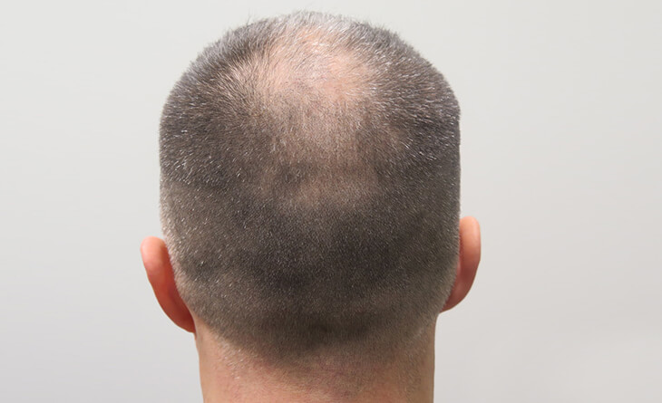 Post Op Recovery Photographs  2 Weeks After FUE Hair Transplant Procedure