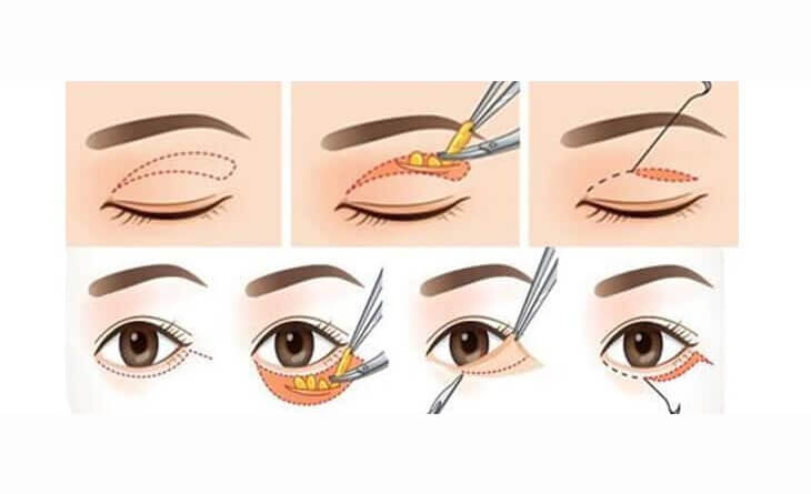 Asian Blepharoplasty Procedure