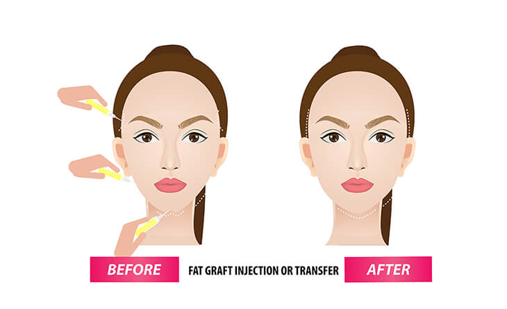 Facial Fat Grafting Procedure