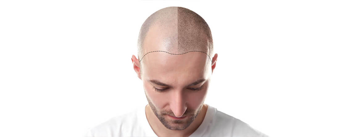 Hair Transplant in Istanbul  Costs and Procedure in Turkey 2023