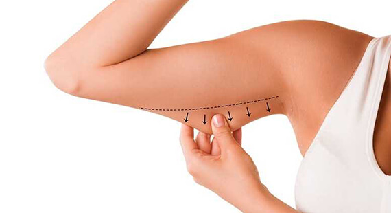 Arm Lift Surgeryin Delhi