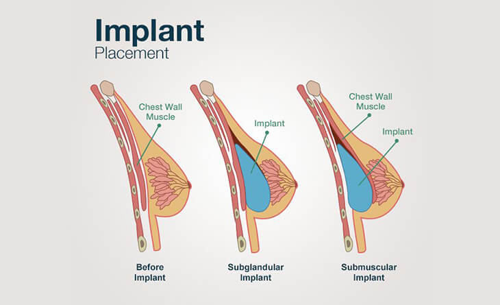 The five factors of breast augmentation