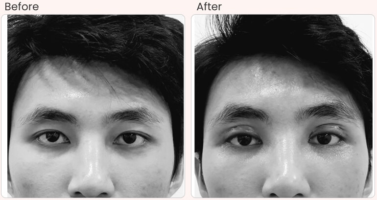 Asian on sale blepharoplasty cost