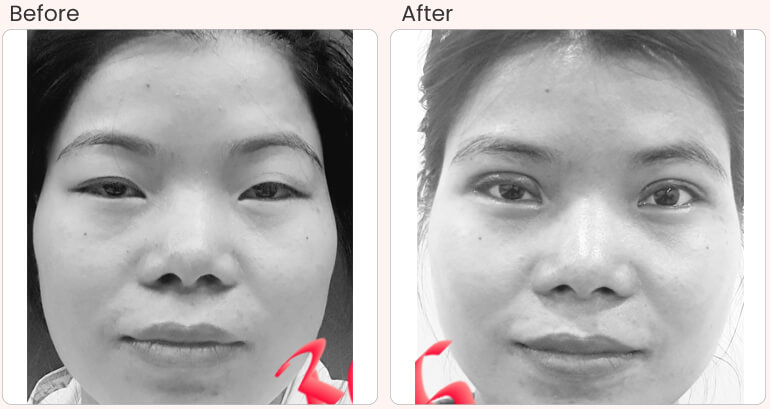 Asian eye bag clearance surgery