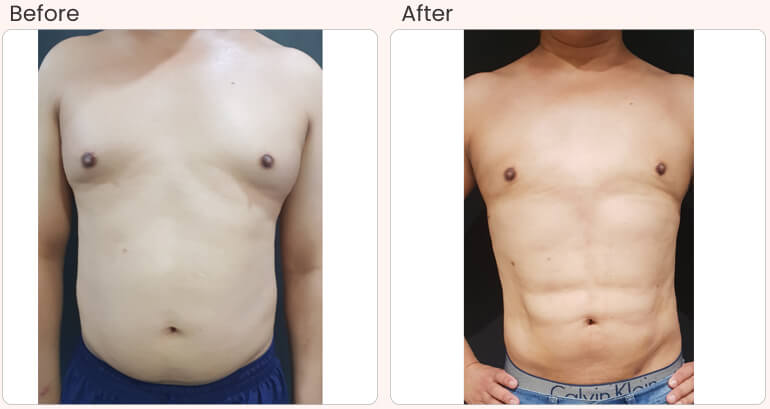 Six Pack Abs Surgery Mumbai  Six Packs Treatment Cost India