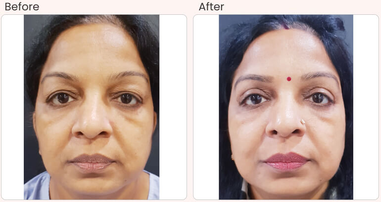How Eye Bag Removal Surgery Lower Blepharoplasty is Done More Safely   YouTube