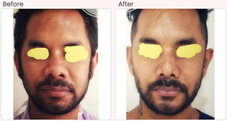 Face Slimming Treatment, Delhi