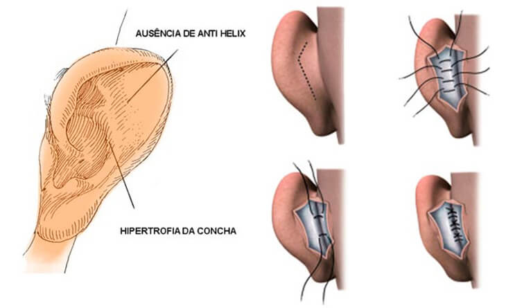 Otoplasty