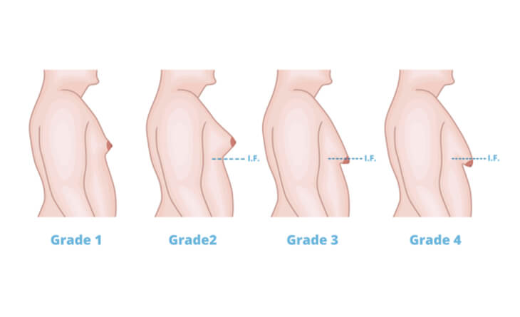 Why Women (and Men) Choose Breast Reduction - North Texas Plastic