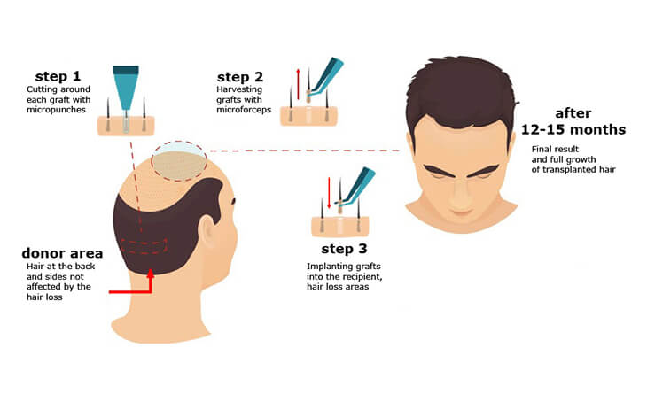 Hair Transplant Surgery