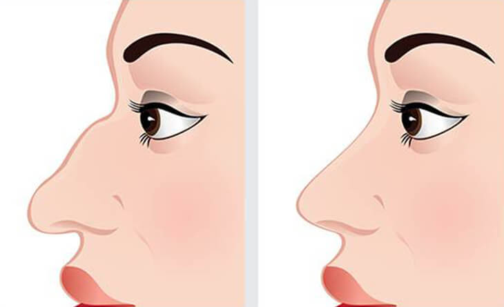 Nose Job - Rhinoplasty Surgery in delhi - Dr Rajat Gupta - Plastic Surgeon in Delhi -033