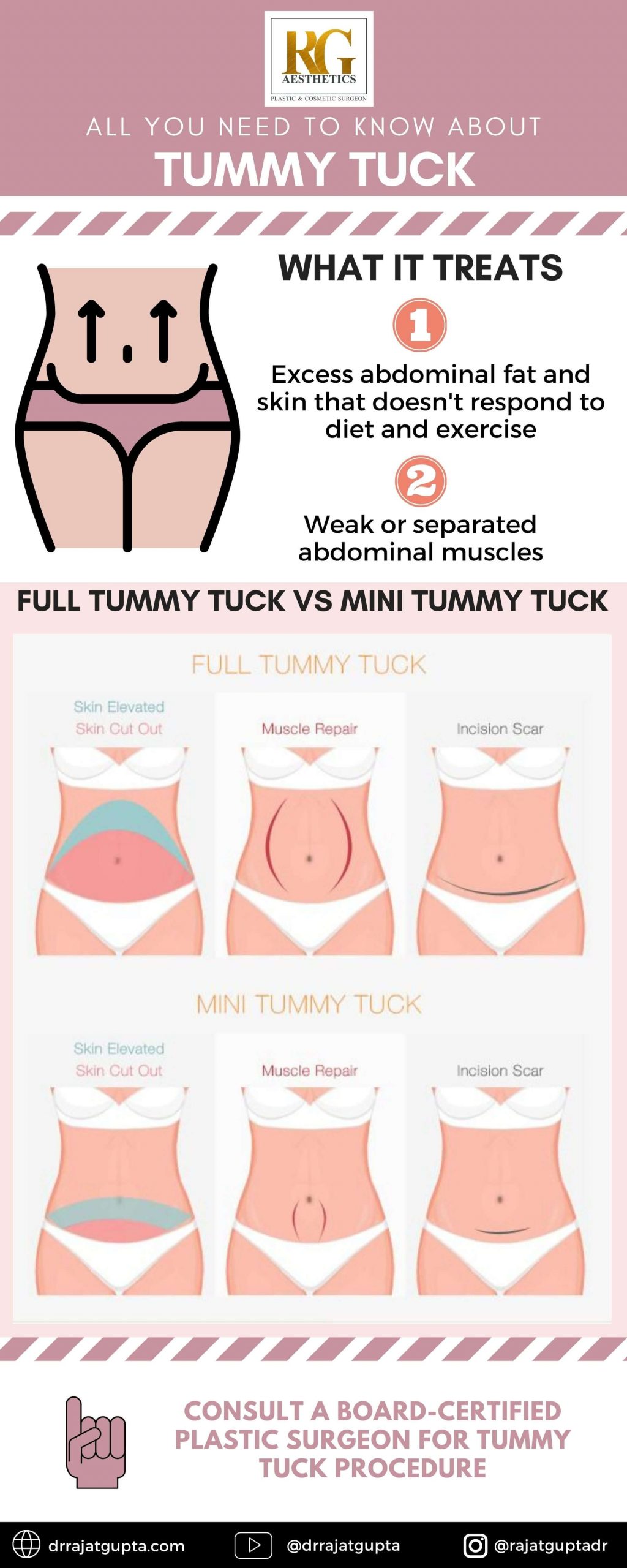 mini tummy tuck vs full tummy tuck recovery