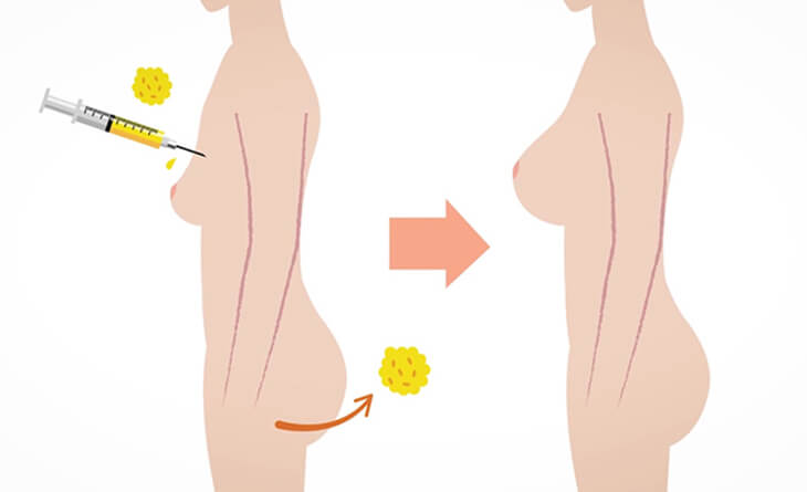 Breast and Buttock Augmentation Using Fat Grafting The Full Overview