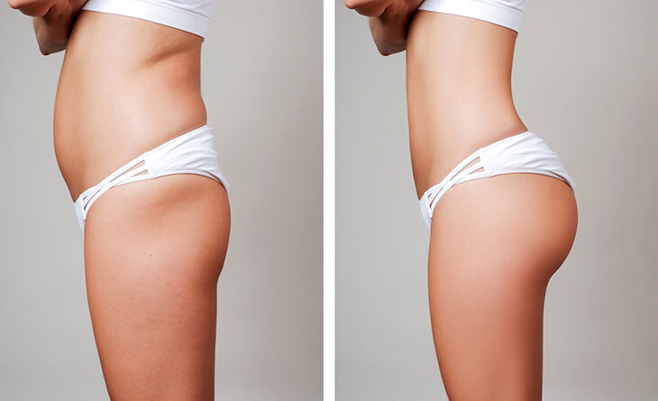 Face, Breasts, Buttocks: How Fat Transfer Sculpts Your Body – Commonwealth  Plastic Surgery