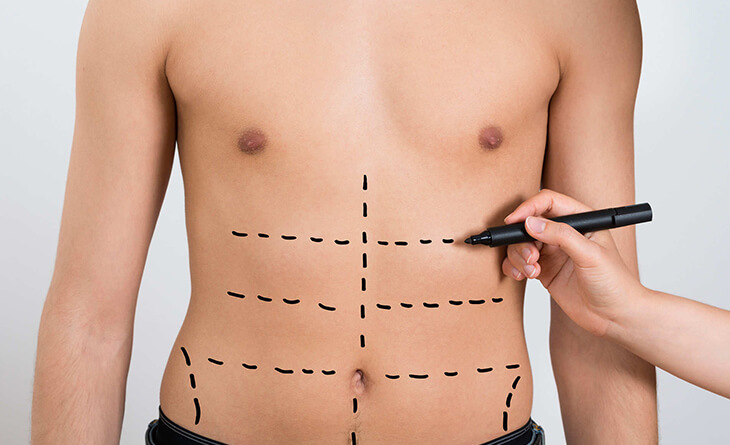 Are 6-pack Abs Possible after a Male Tummy Tuck? Yes, They Are! –  Aristocrat Plastic Surgery