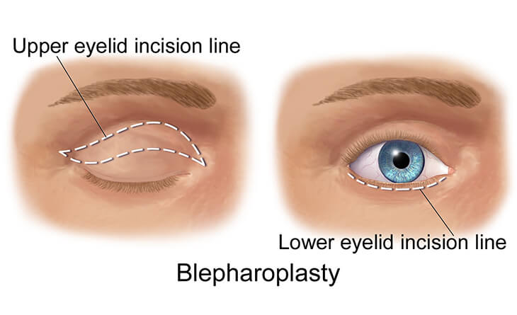 Blepharoplasty in Delhi
