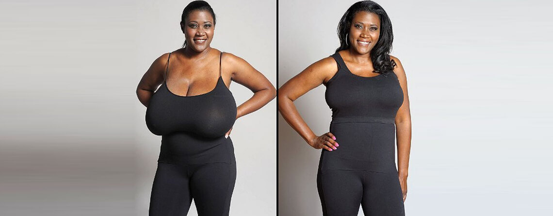 A breast reduction can bring balance to your figure. 