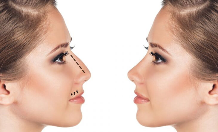 Nose Job or Rhinoplasty