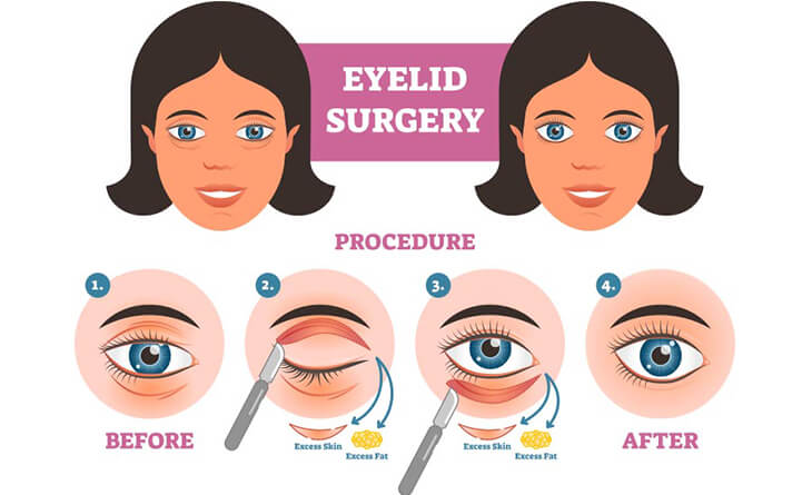 Blepharoplasty Surgery in Delhi