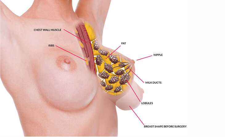 breast lift procedure