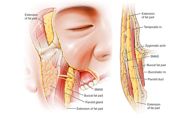 Buccal Pad Fat Removal in delhi