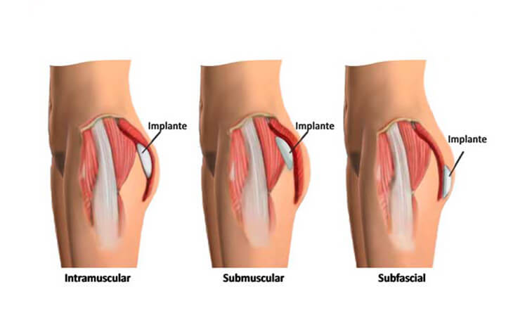 HOW I DO IT - Buttock augmentation