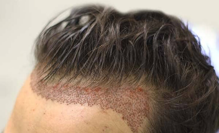 Hair Transplant in Delhi