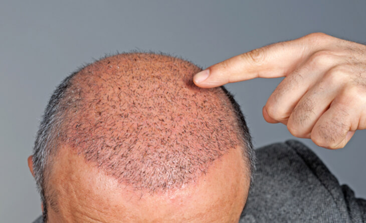 hair transplant