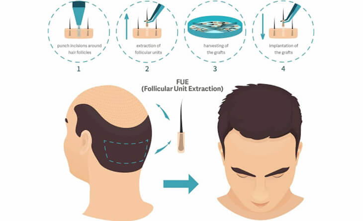 hair transplant