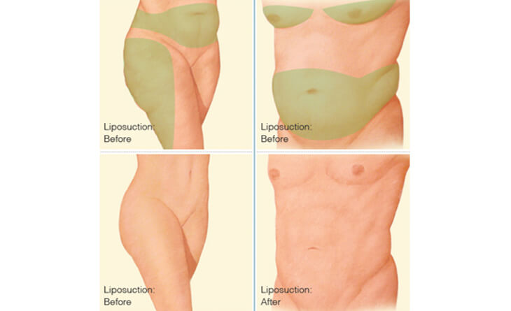 Can Men Benefit from Full Body Liposuction Surgery?