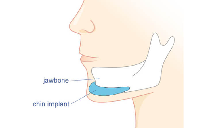 Chin augmentation in Delhi