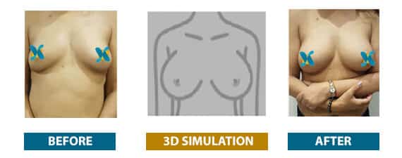 See yourself with breast implants in 3D. Compare implant size, shape, and  profile at:  #crisalix3d