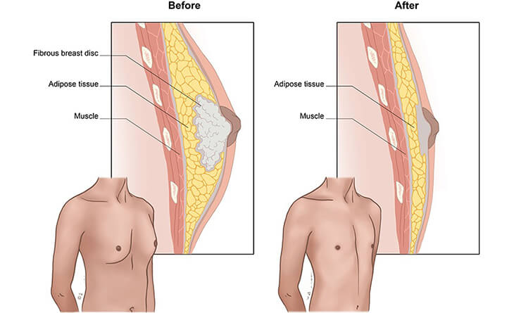 Exercise for gynecomastia at home new arrivals