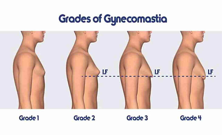 Patient A - Grade IIA Gynecomastia - full female size breast with