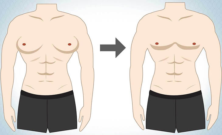 Side effects after gynecomastia surgery