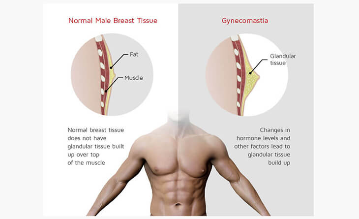 Gynecomastia surgery bruising