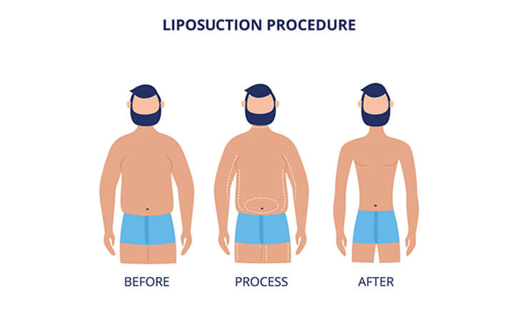 Liposuction Procedure