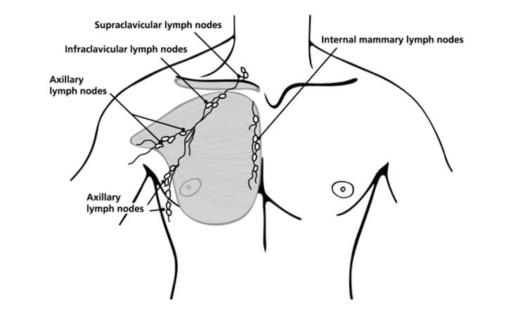 gynecomastia surgery in delhi